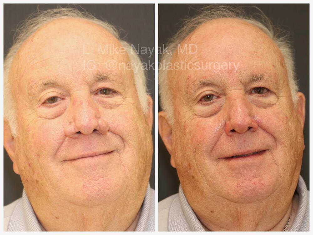 Rhinophyma Reduction Before & After Image