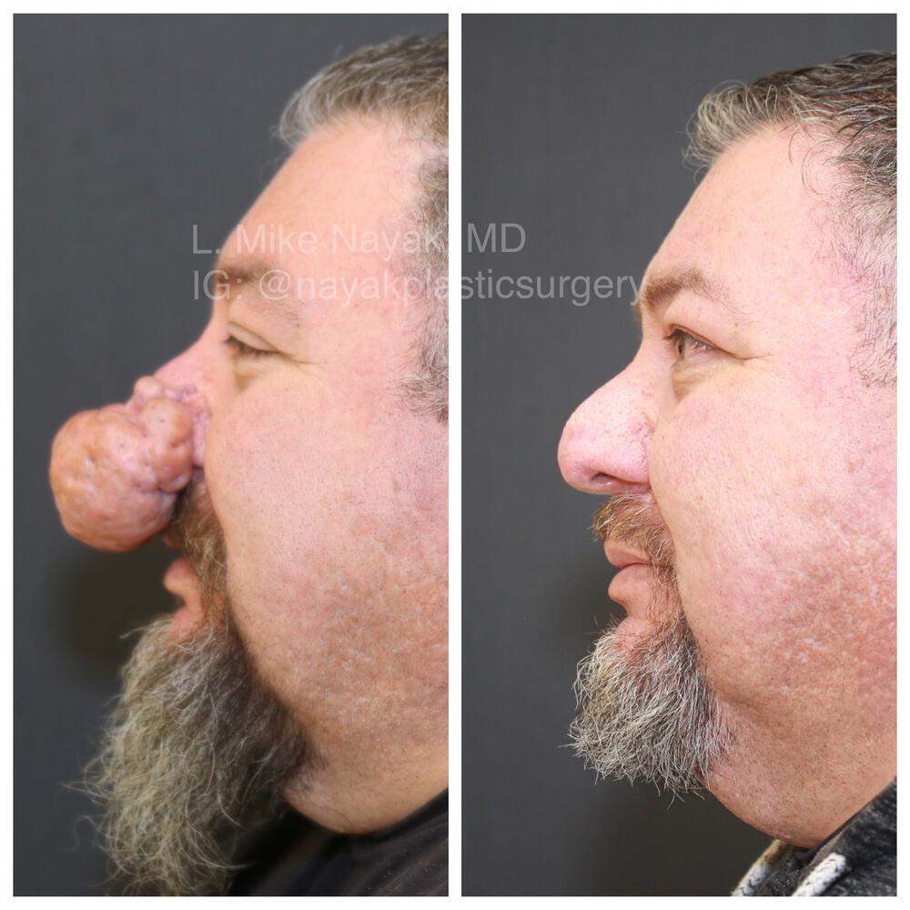 Rhinophyma Reduction Before & After Image