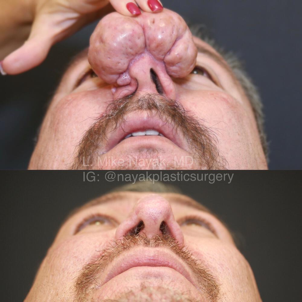 Rhinophyma Reduction Before & After Image