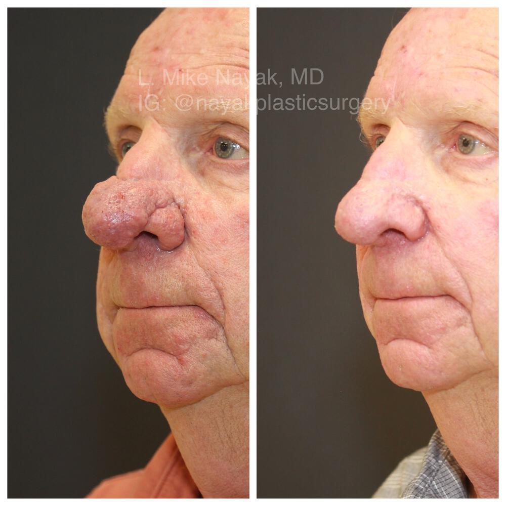 Rhinophyma Reduction Before & After Image