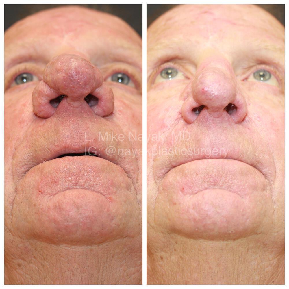 Rhinophyma Reduction Before & After Image