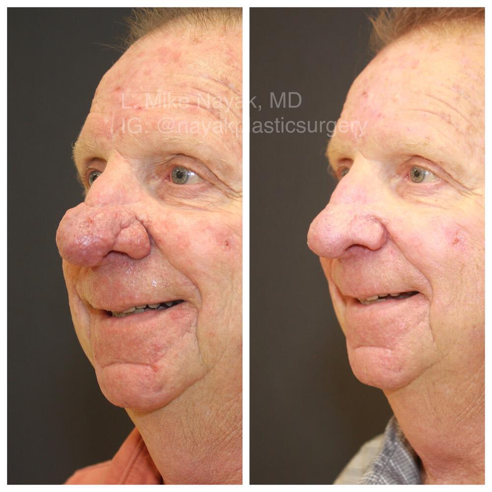 Rhinophyma Reduction Before & After Image