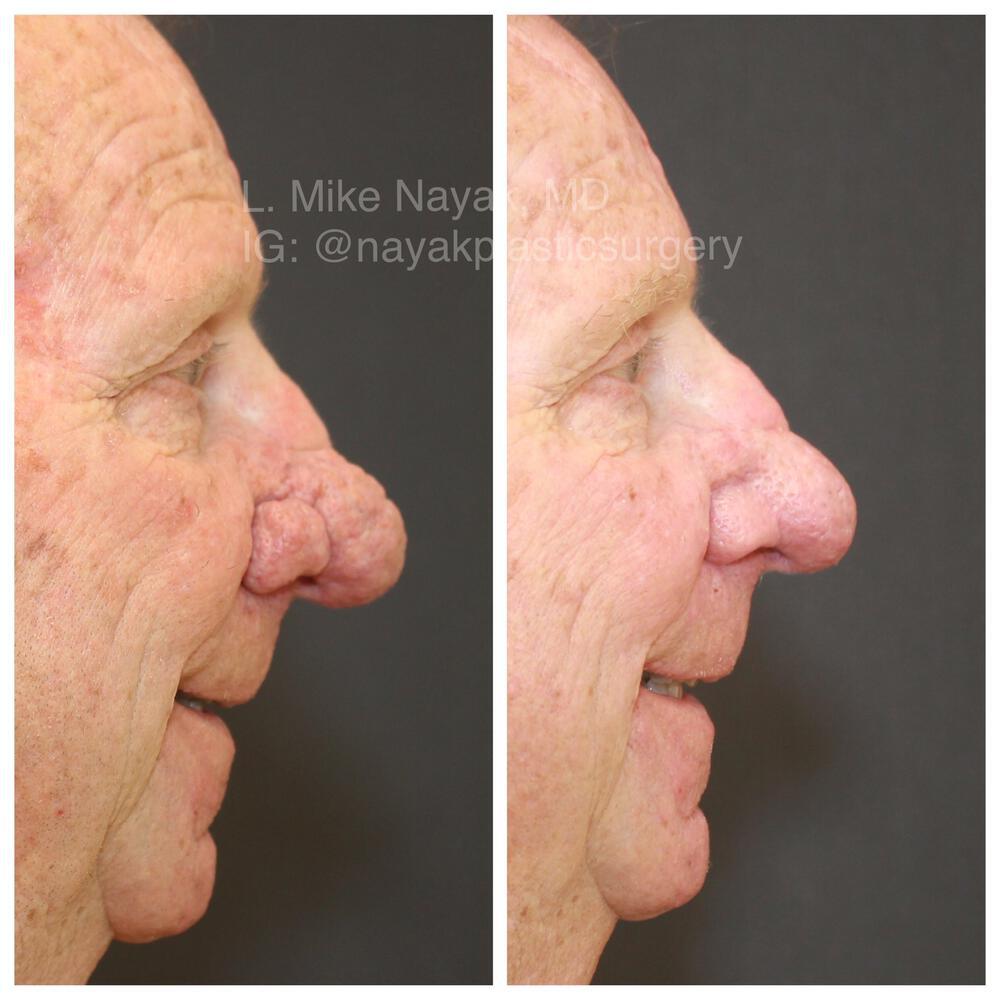 Rhinophyma Reduction Before & After Image