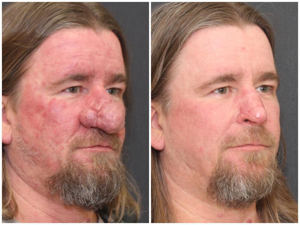 Rhinophyma Reduction Before & After Image