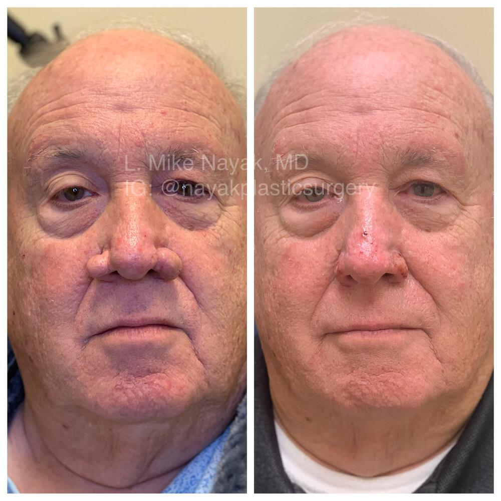 Rhinophyma Reduction Before & After Image