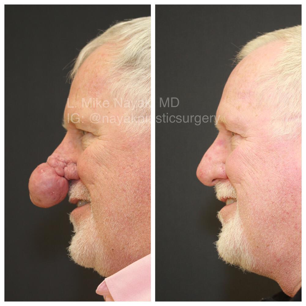 Rhinophyma Reduction Before & After Image