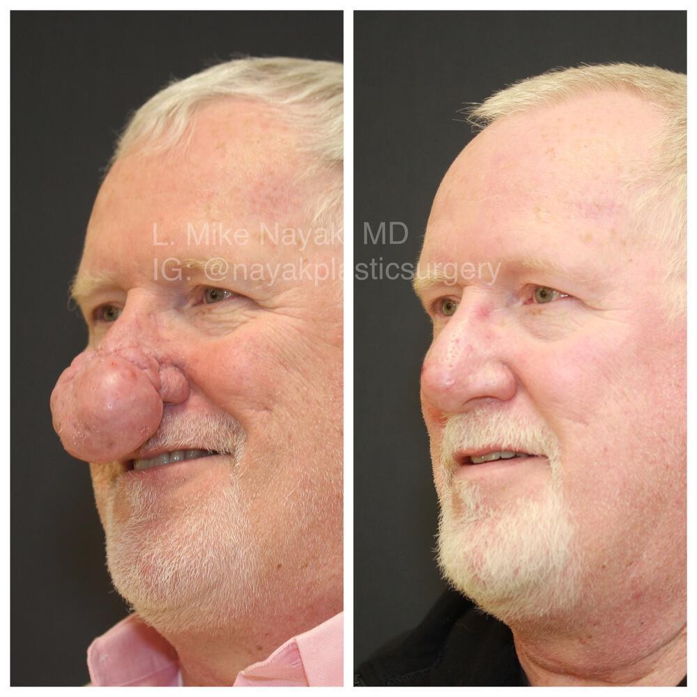 Rhinophyma Reduction Before & After Image