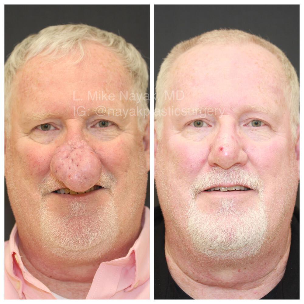 Rhinophyma Reduction Before & After Image