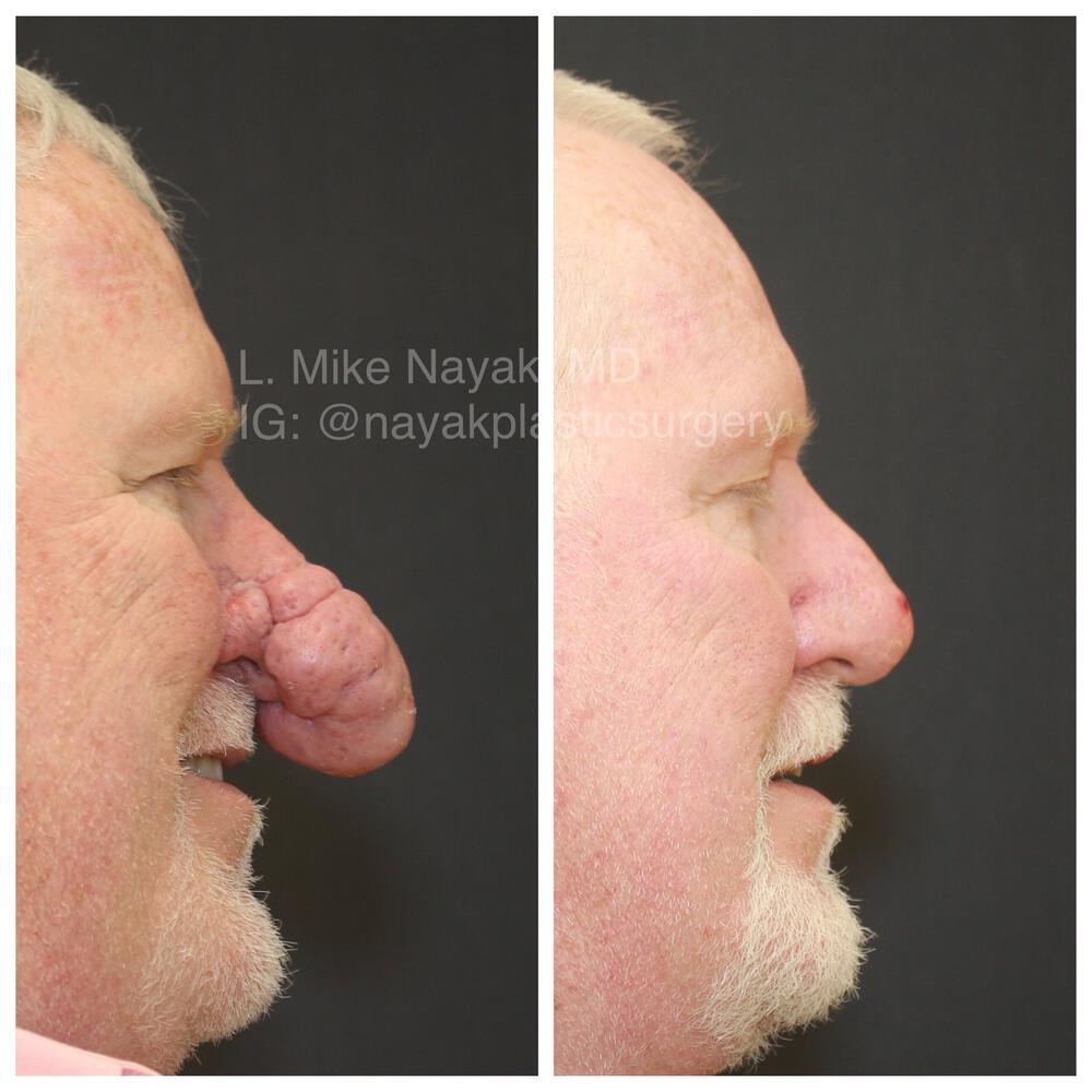 Rhinophyma Reduction Before & After Image