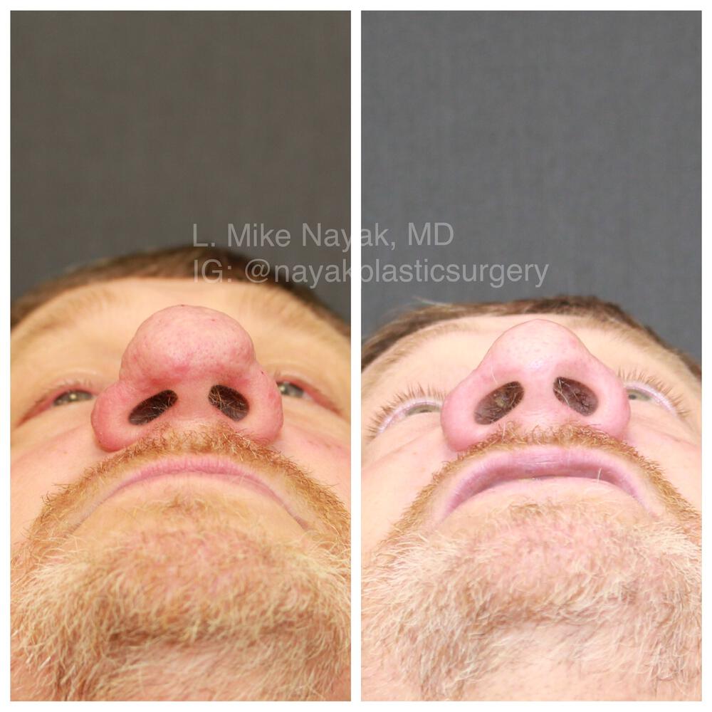 Rhinophyma Reduction Before & After Image