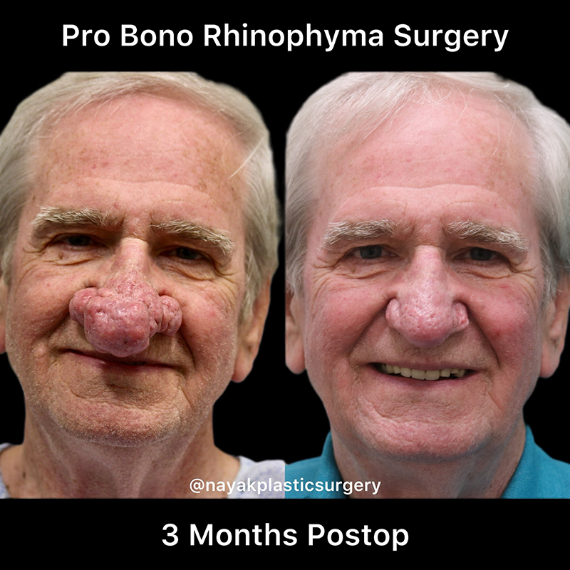 Rhinophyma Reduction Before & After Image