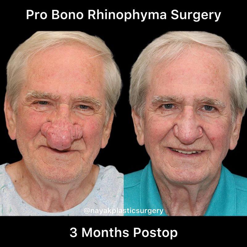 Rhinophyma Reduction Before & After Image