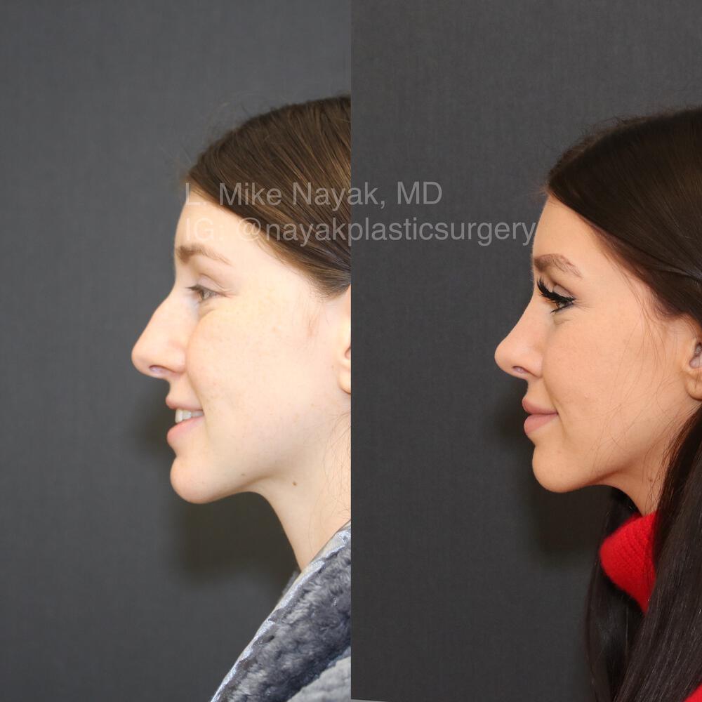 Rhinoplasty Before & After Image