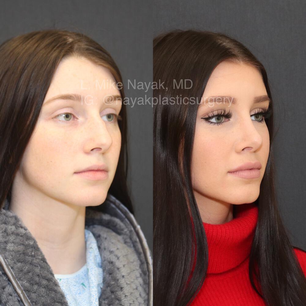 Rhinoplasty Before & After Image