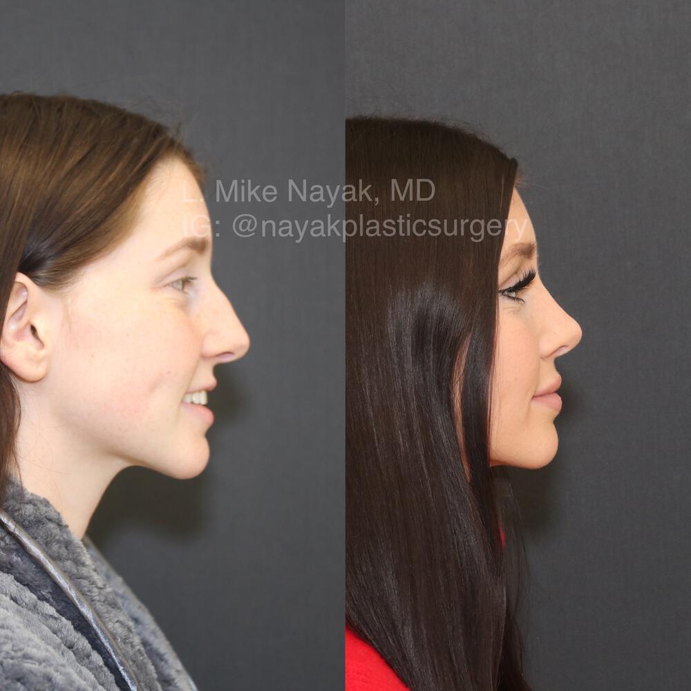 Rhinoplasty Before & After Image