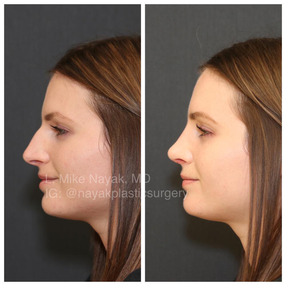 Rhinoplasty Before & After Image