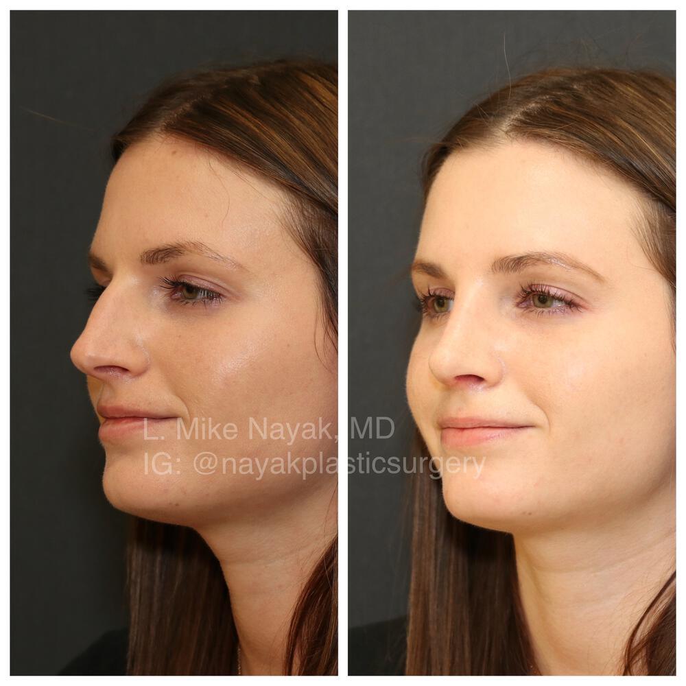 Rhinoplasty Before & After Image