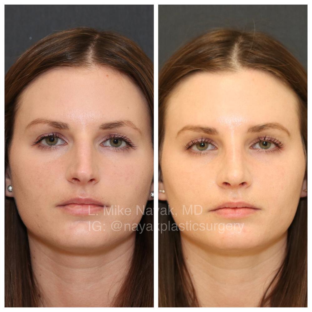 Rhinoplasty Before & After Image