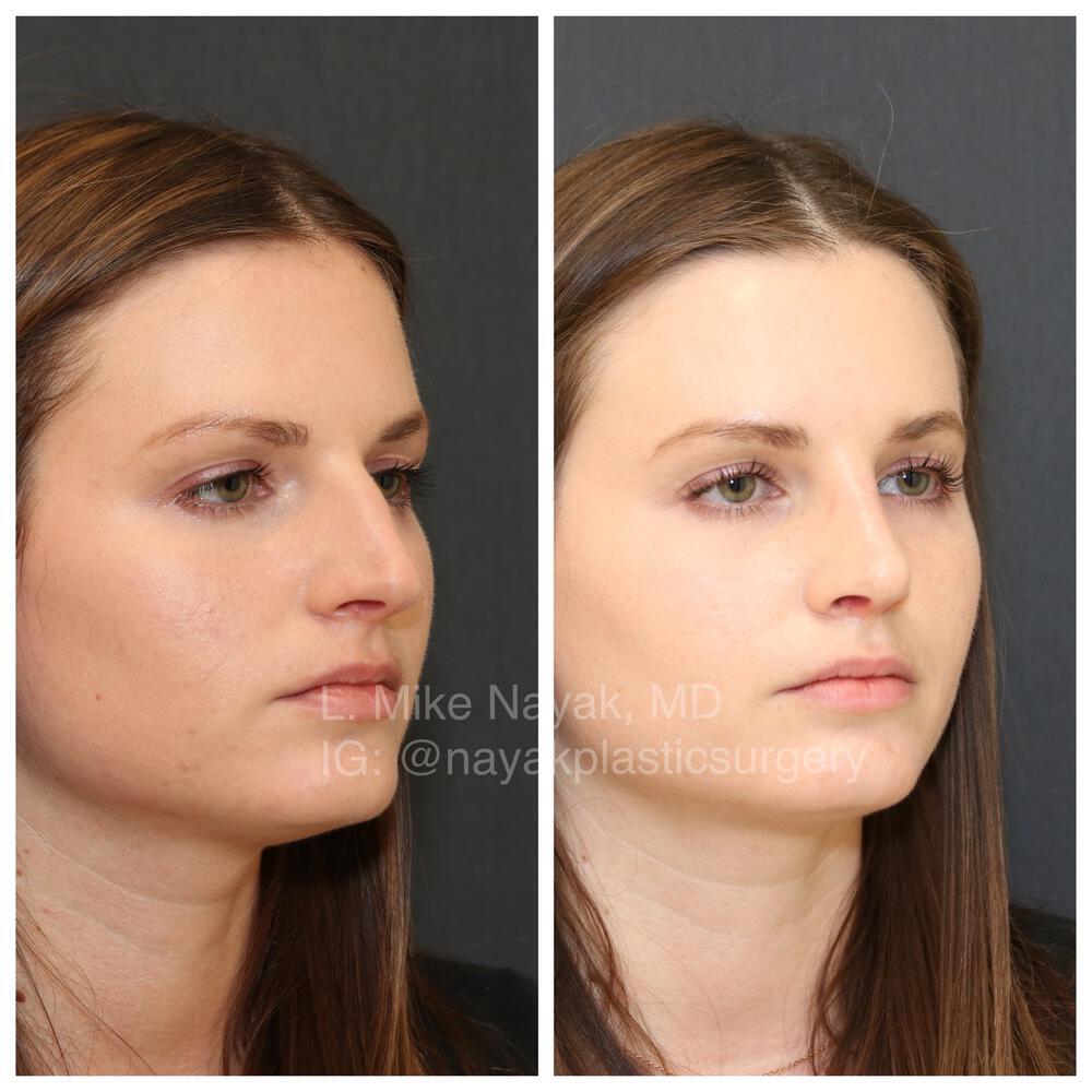 Rhinoplasty Before & After Image