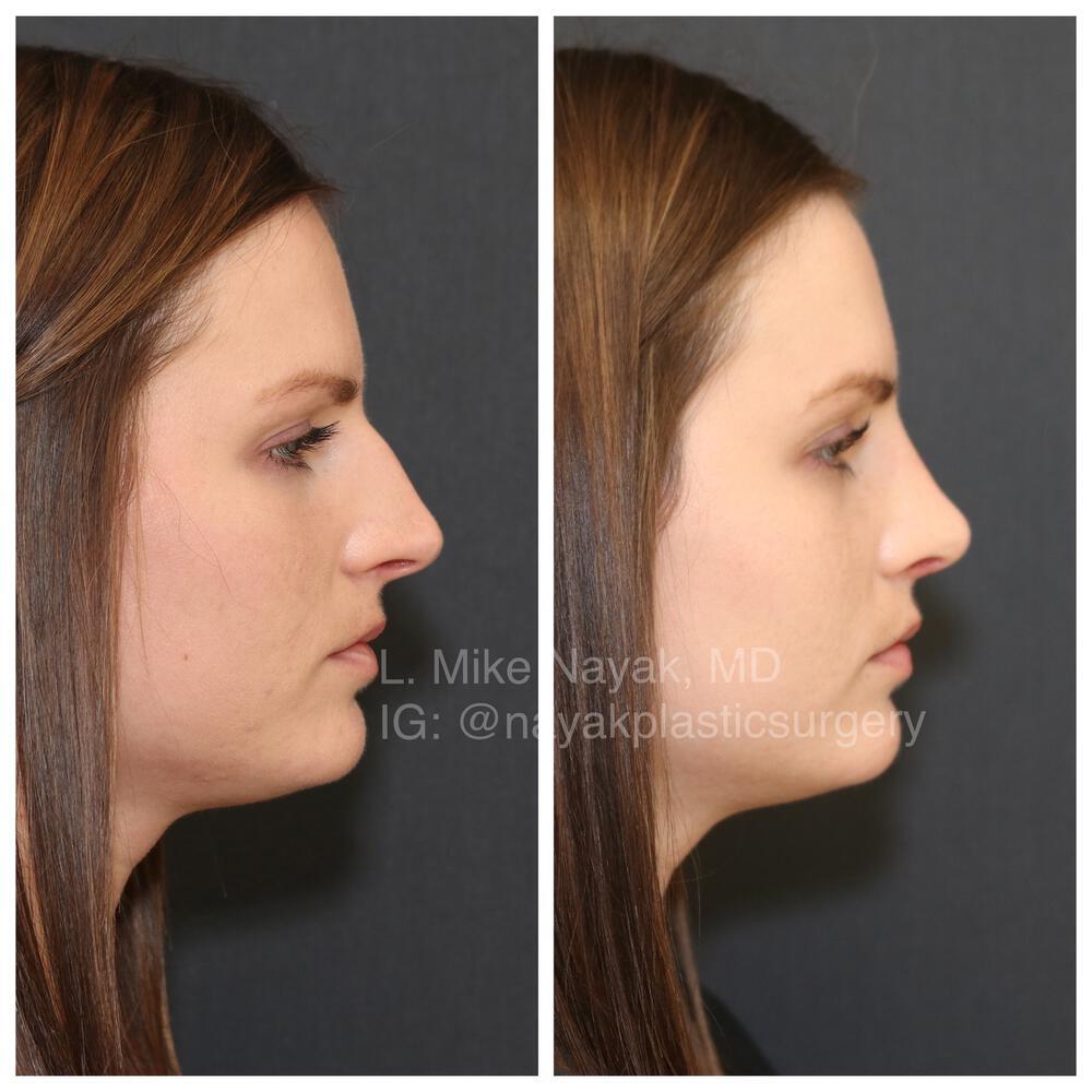 Rhinoplasty Before & After Image