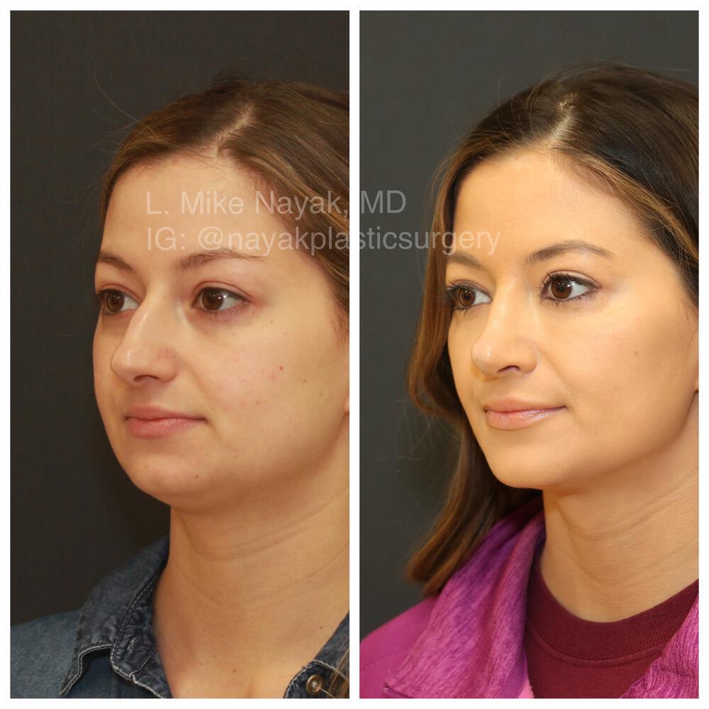 Rhinoplasty Before & After Image