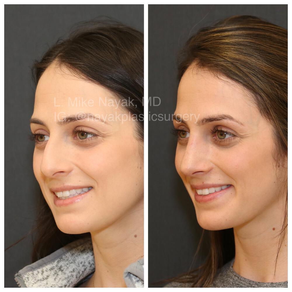 Rhinoplasty Before & After Image