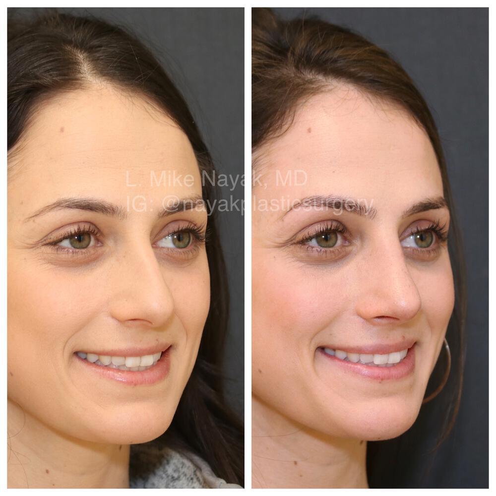 Rhinoplasty Before & After Image