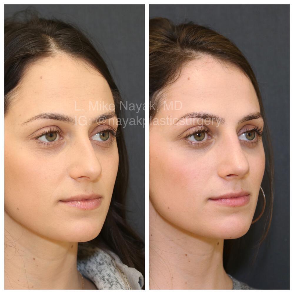 Rhinoplasty Before & After Image