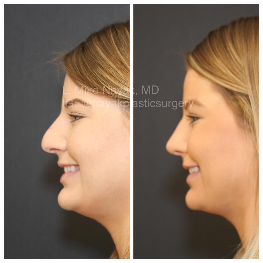 Rhinoplasty Before & After Image