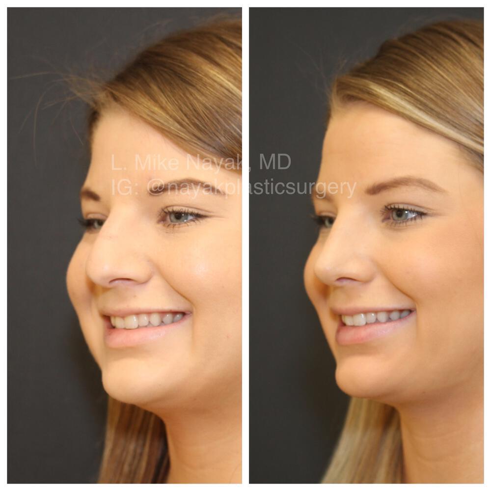 Rhinoplasty Before & After Image