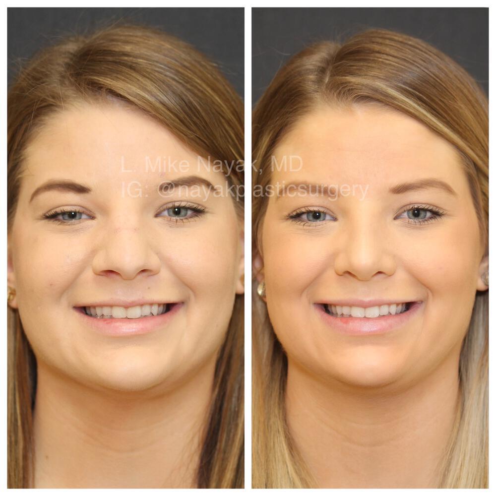 Rhinoplasty Before & After Image