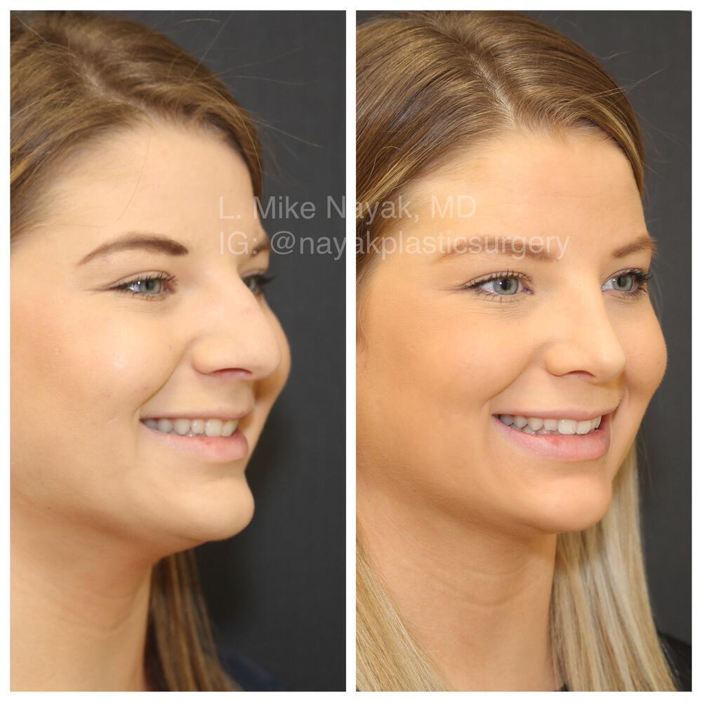 Rhinoplasty Before & After Image