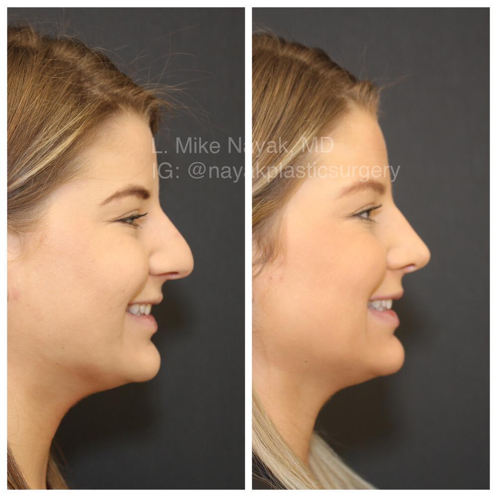 Rhinoplasty Before & After Image