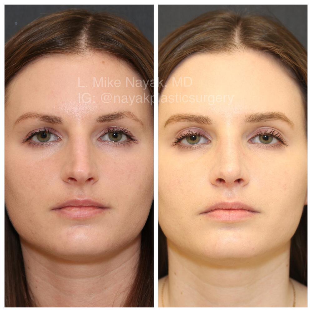 Rhinoplasty Before & After Image