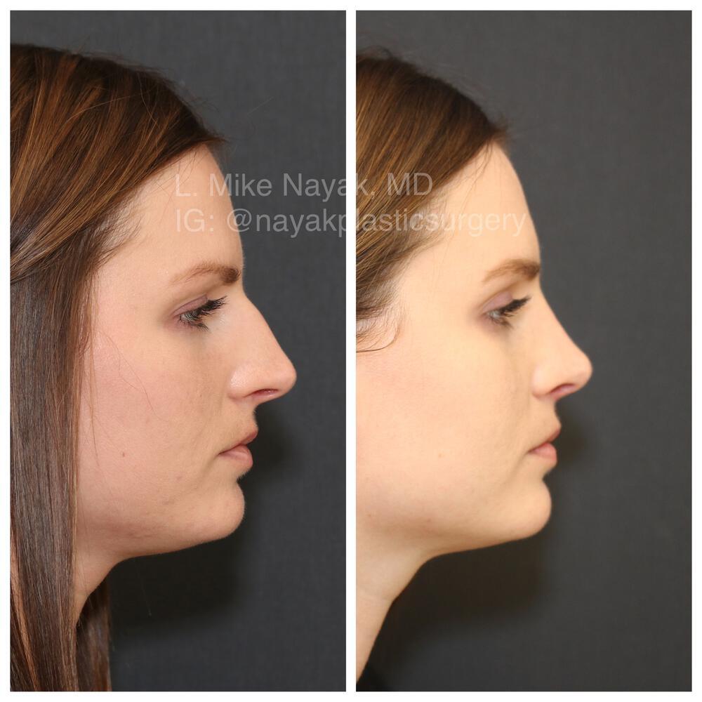 Rhinoplasty Before & After Image