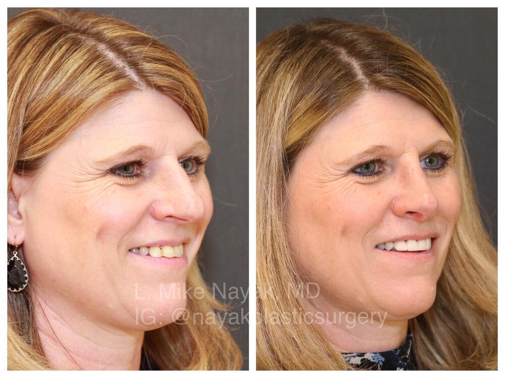 Rhinoplasty Before & After Image