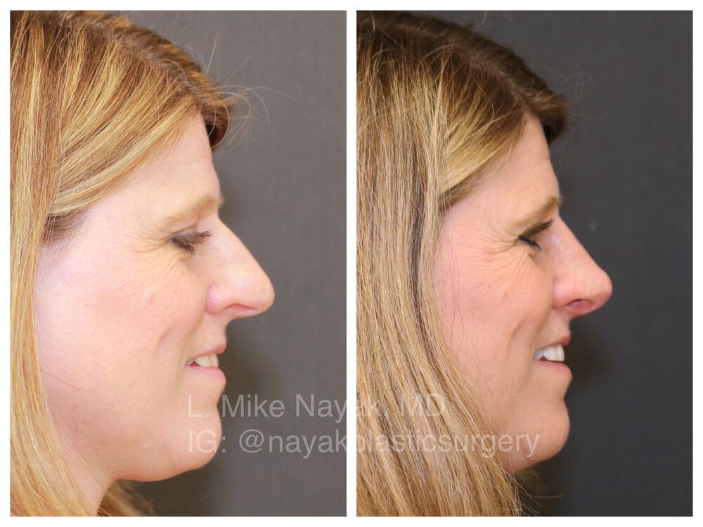 Rhinoplasty Before & After Image