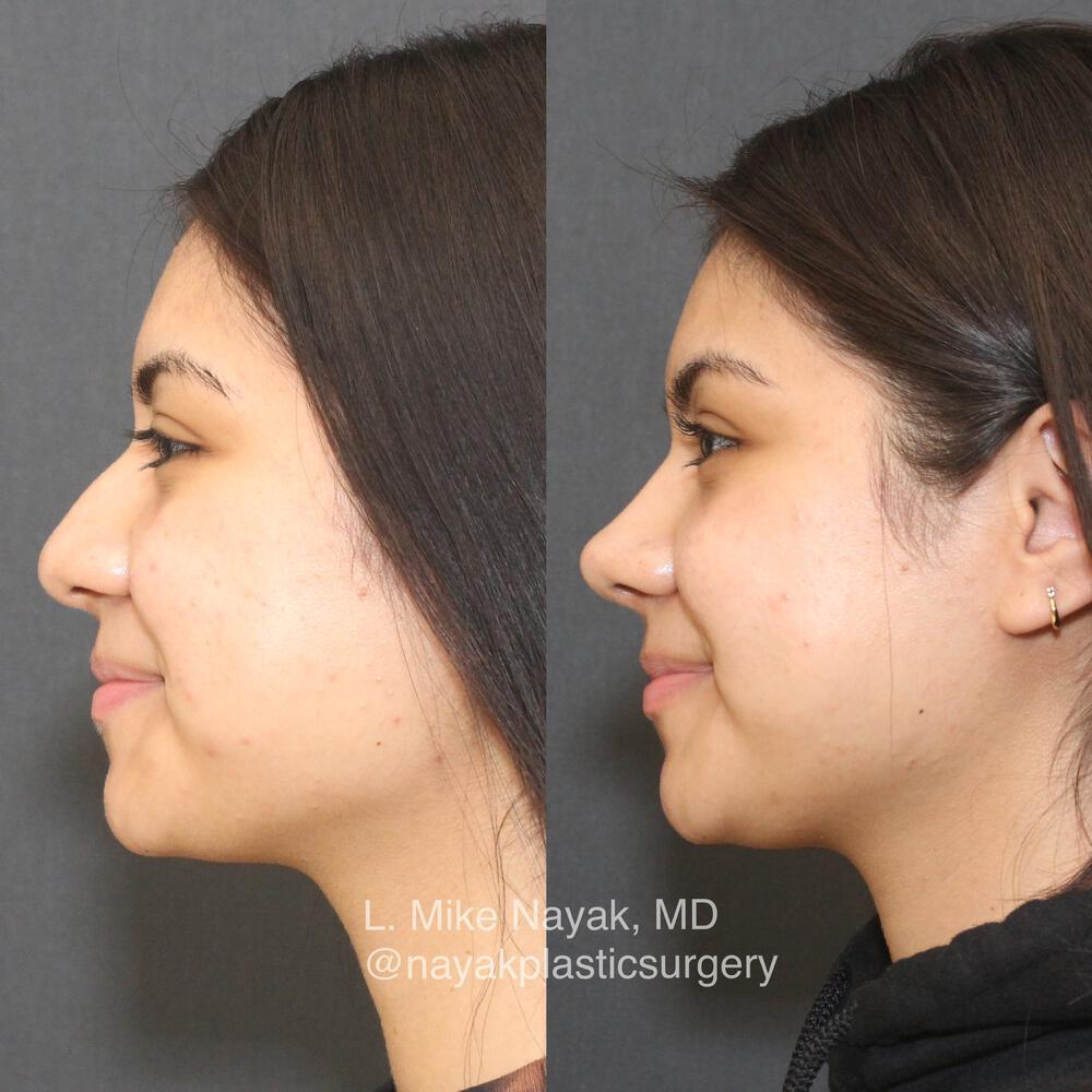 Rhinoplasty Before & After Image