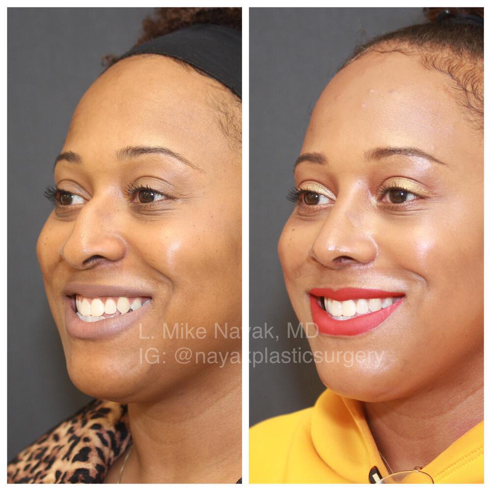 Rhinoplasty Before & After Image