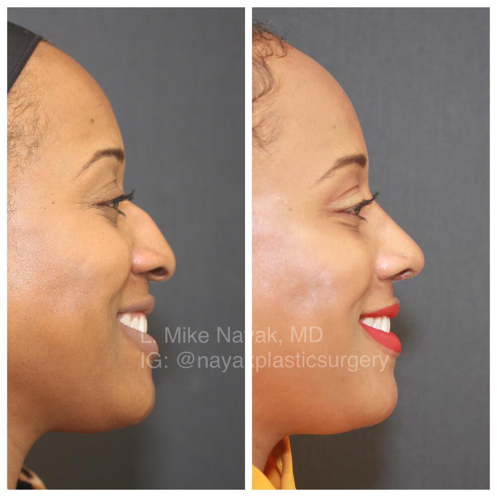 Rhinoplasty Before & After Image