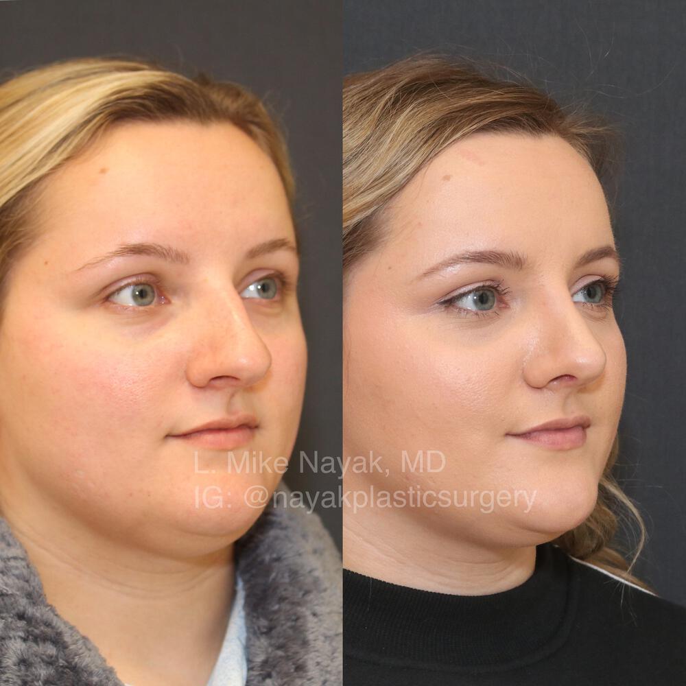 Rhinoplasty Before & After Image