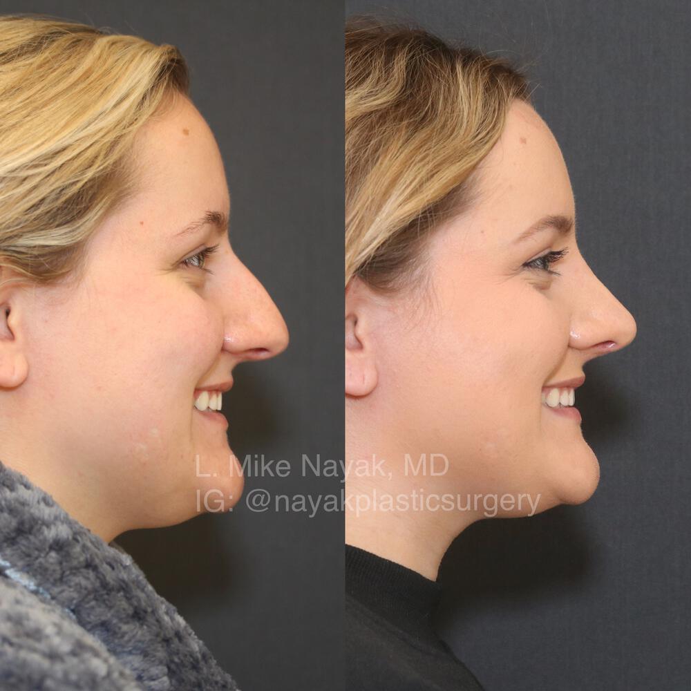 Rhinoplasty Before & After Image