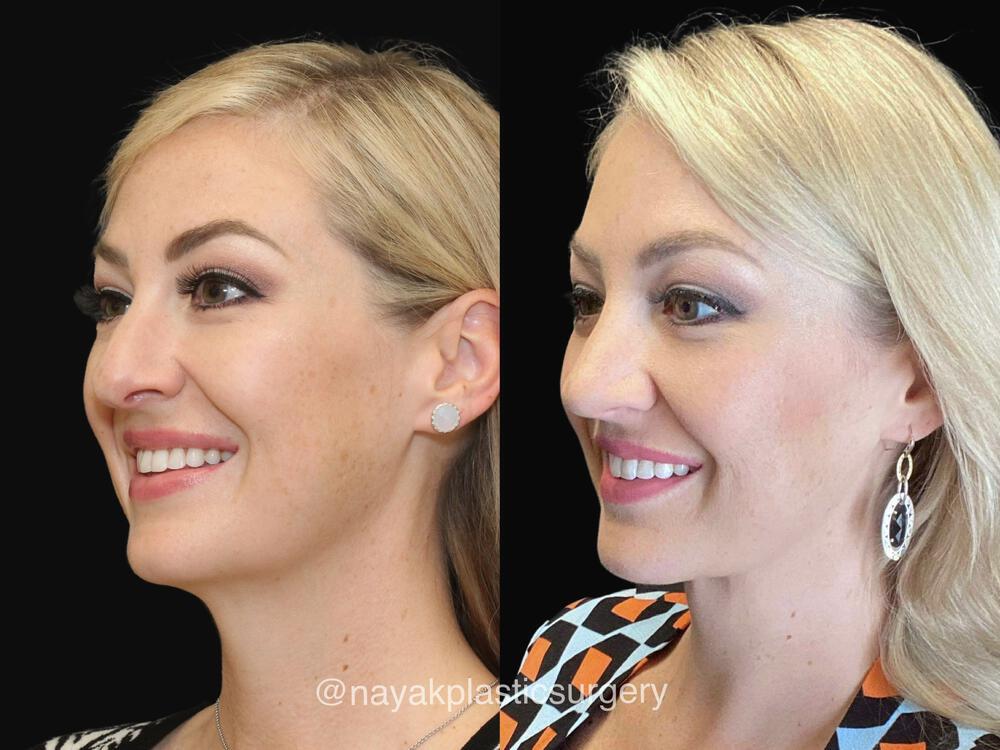 Rhinoplasty Before & After Image