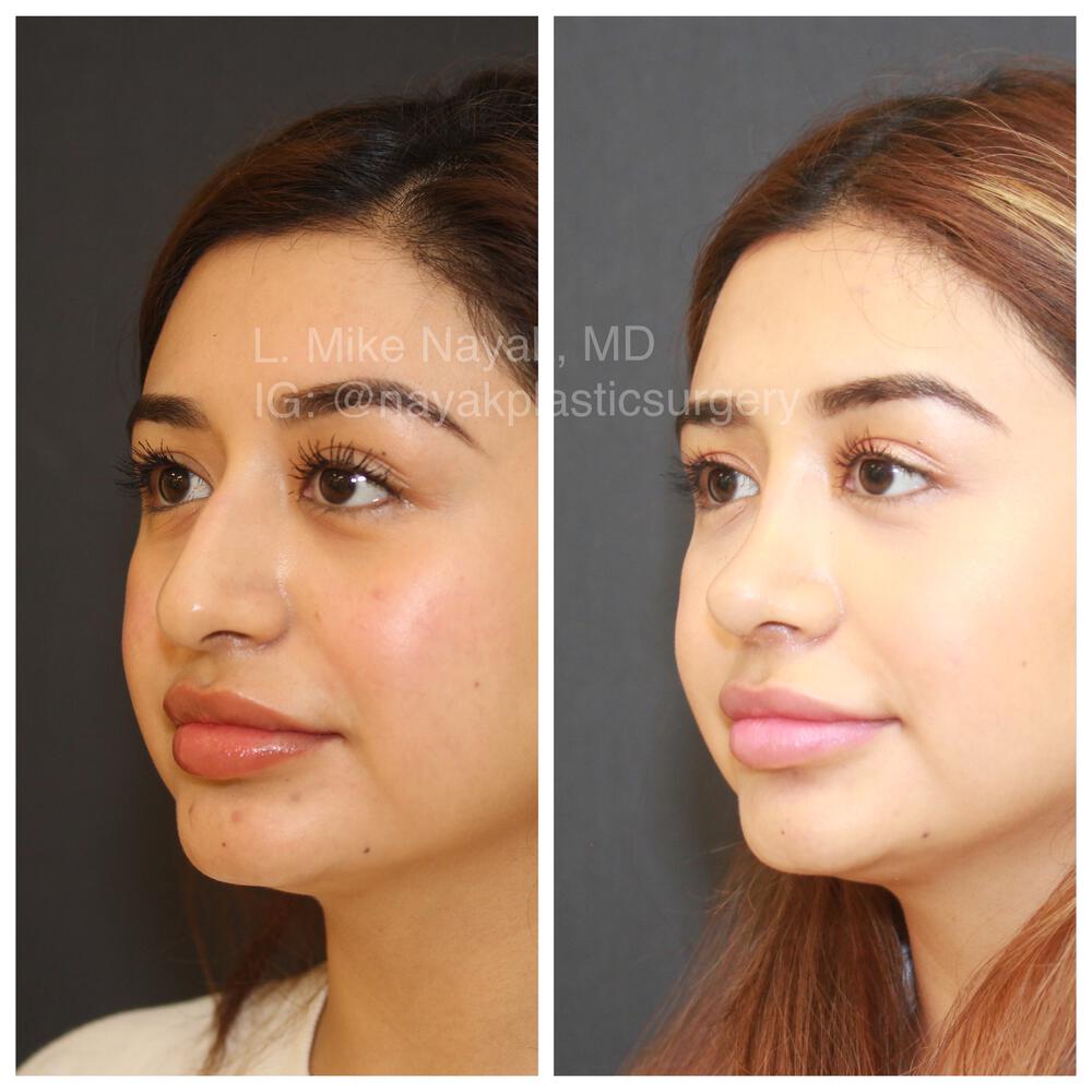 Rhinoplasty Before & After Image