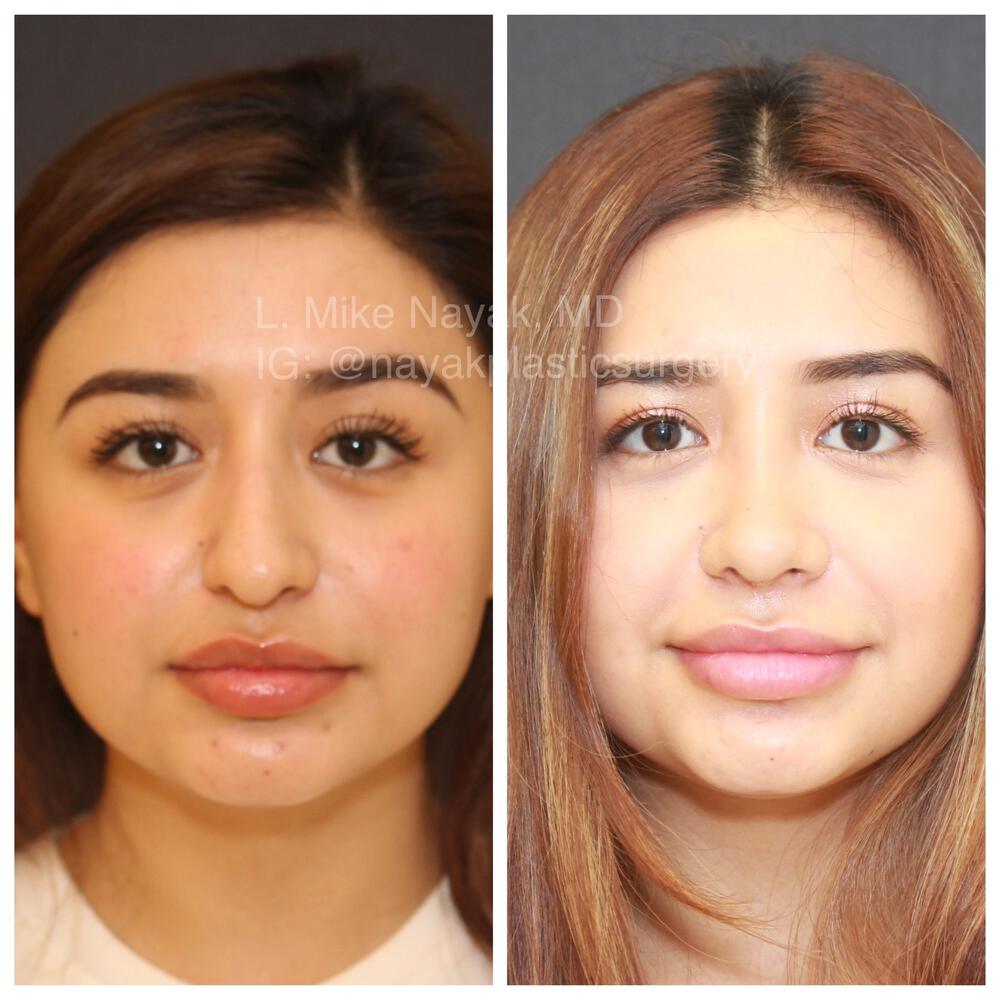 Rhinoplasty Before & After Image