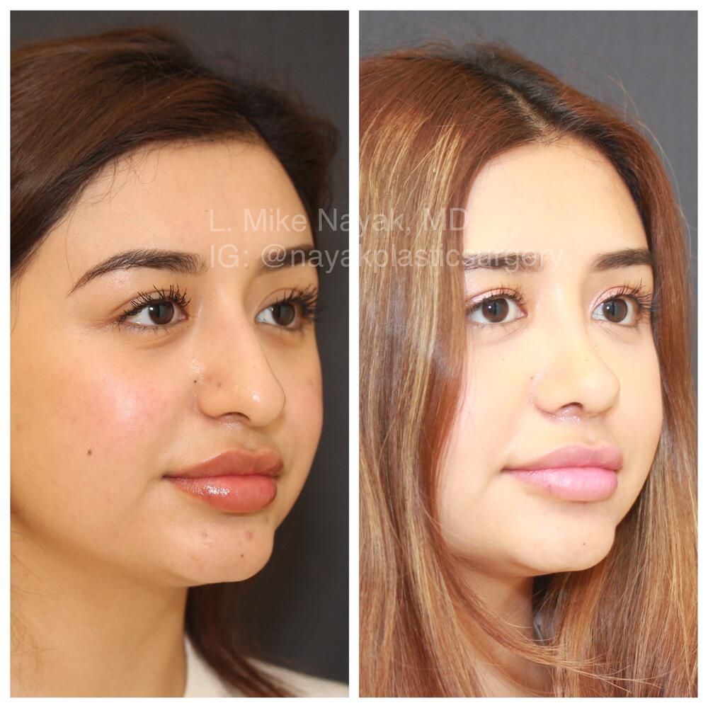 Rhinoplasty Before & After Image