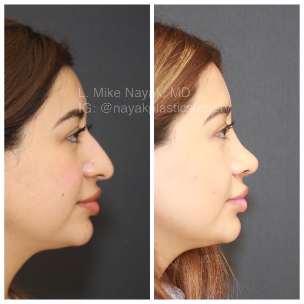 Rhinoplasty Before & After Image