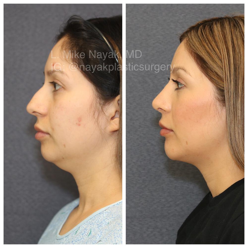 Rhinoplasty Before & After Image