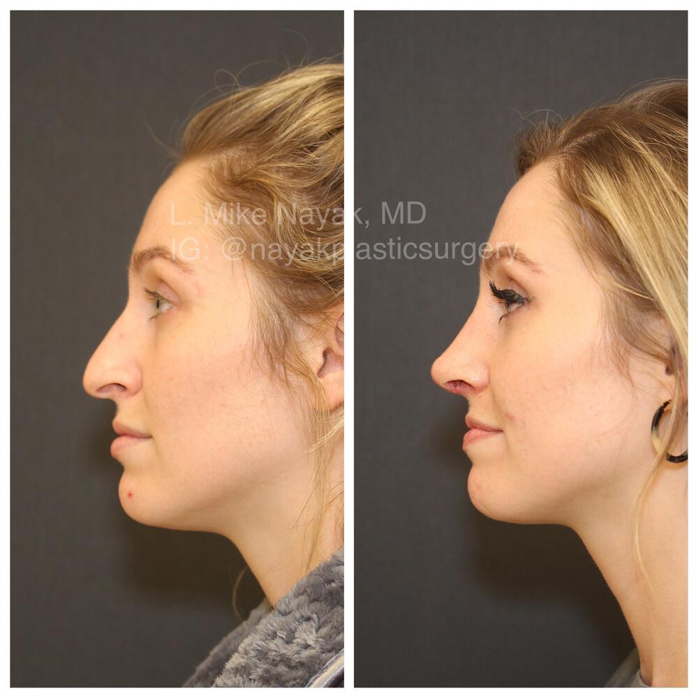 Rhinoplasty Before & After Image