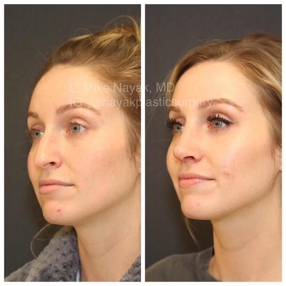 Rhinoplasty Before & After Image